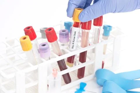 Hepatitis Testing Foto stock