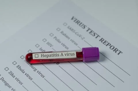 Hepatitis a Virus Test Sample with Medical Report Stock Photos