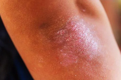 Here is a close up image showcasing a persons elbow that has a rash on it Stock Photos