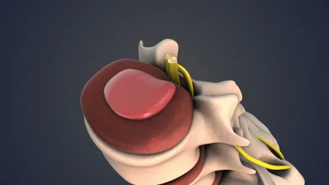 Herinated disc of the lumber spine Stock-Footage 266022073