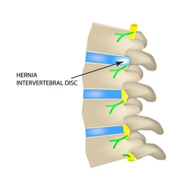 A hernia of the intervertebral disc. Vector illustration on isolated background. Stock Illustration