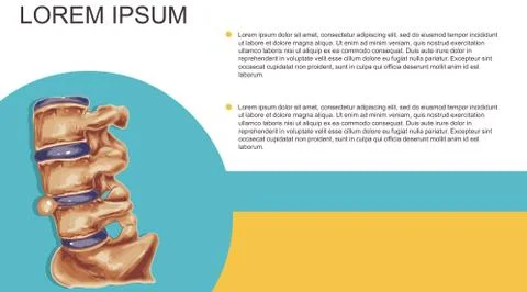 Hernia vector illustration Stock Illustration