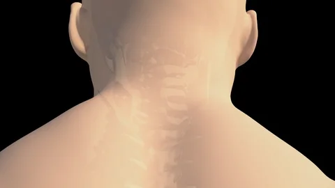 Herniated Cervical Disc Stock-Footage 121111846