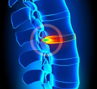 Herniated Disc Degeneration - Spine problem Stock Photos
