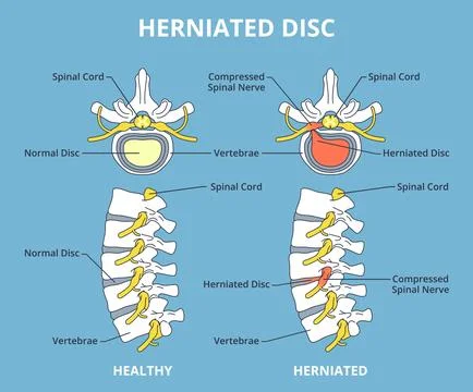 Herniated disc. Sick and healthy spine, medical comparison scheme, nerve Stock Illustration