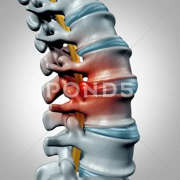 Herniated Disk Stock Illustration