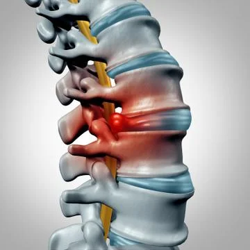 Herniated Disk Stock Illustration