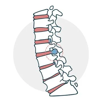 Herniated intervertebral disc icon Stock Illustration