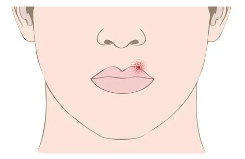 Herpes Stock Illustration