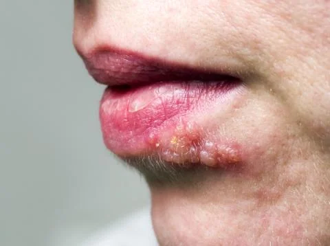 Herpes on lip Stock-Fotos