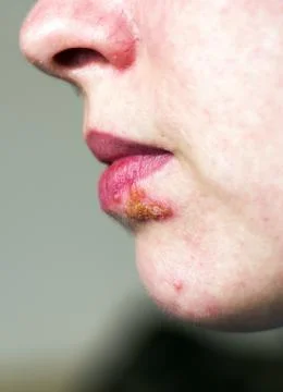 Herpes on lip Stock Photos