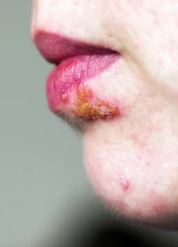 Herpes on lip Stock Photos