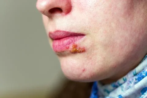 Herpes on lip Foto stock