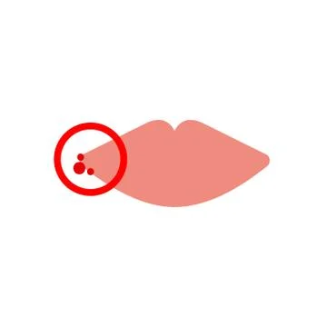 Herpes on lips Stock Illustration