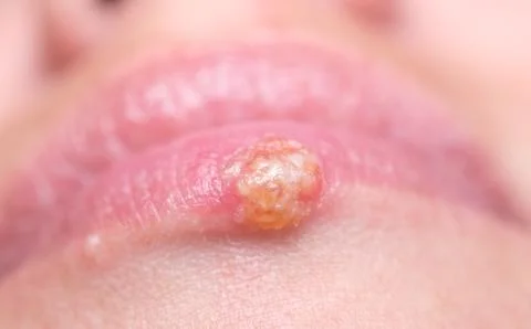 Herpes on lips Stock Photos