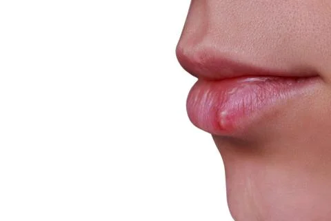 Herpes on the lips Stock Photos