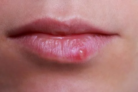 Herpes on the lips Stock Photos