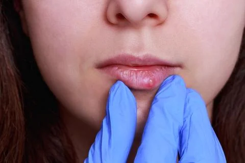 Herpes on the lips Stock Photos