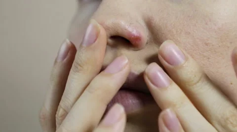 Herpes on the nose - young woman with herpes on her nose Stock-Footage 59643462