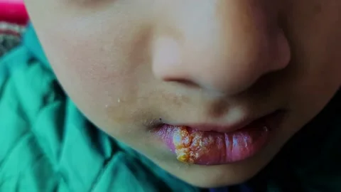 Herpes simplex Infection on boy lip fung... | Stock Video | Pond5