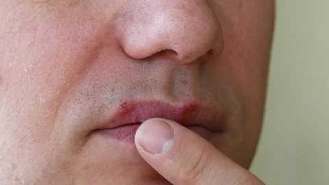 Herpes simplex virus infection. Lips treatment by cream. Male face. slow motion Stock Footage 87543818