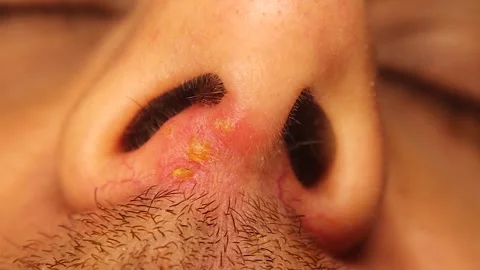 Herpes Simplex Virus Type 1 Mouth Infection After Severe Flu Fever Stock Footage 324495530