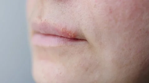 Herpes sore on lips vesicles small bumps pimples blisters on upper lip female Stock Footage 235235494
