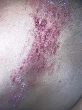 Herpes Zoster Stock Photos