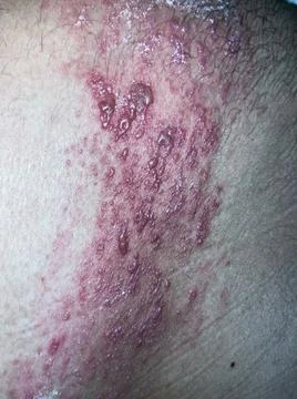 Herpes Zoster Stock Photos