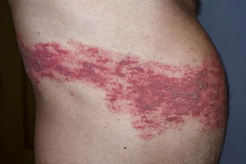 Herpes Zoster Stock Photos