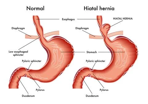 Hiatal hernia Stock Illustration