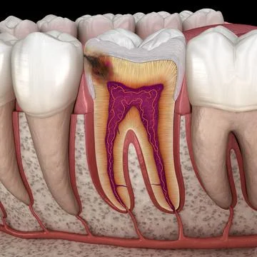 Hidden caries in to molar tooth. Medically accurate 3D illustration Stock Illustration