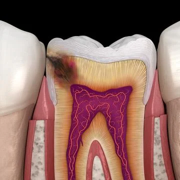 Hidden caries in to molar tooth. Medically accurate 3D illustration Stock Illustration
