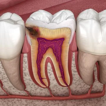 Hidden caries in to molar tooth. Medically accurate 3D illustration Illustrazione stock