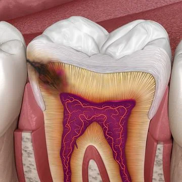 Hidden caries in to molar tooth. Medically accurate 3D illustration Stock Illustration