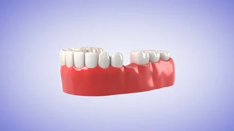 High quality 3D animation showing the installation process of dental implants. Stock Footage 78698507