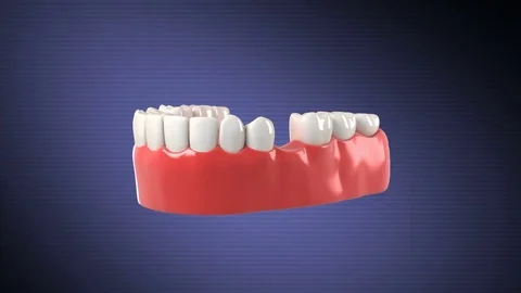 High quality 3D animation showing the installation process of dental implants. Stock Footage 78856933
