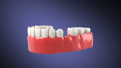 High quality 3D animation showing the installation process of dental implants. Stock Footage 78857382