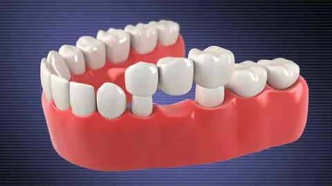 High quality 3D animation showing the installation process of Tooth Bridge. Stock Footage 85303285