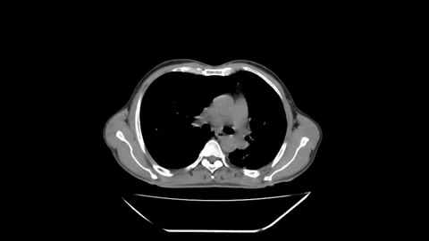 High-Resolution Chest CT Scan (HRCT) of the Thorax Stock Footage 279136262