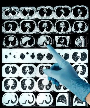 High resolution computed tomography images thorax in axial, coronal planes ha Stock Photos