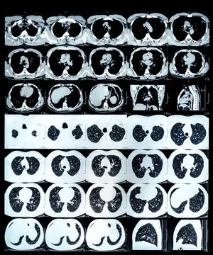 High resolution computed tomography images of a normal thorax in axial, coron Stock Photos