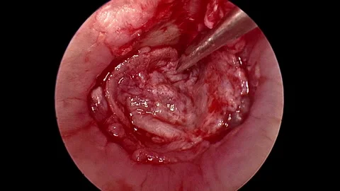 High-resolution endoscopic footage of an ear surgery procedure performed in... Stock Footage 341773973