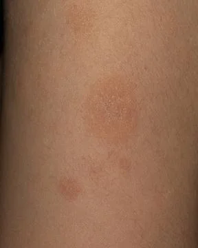 High-resolution image capturing a detailed view of human skin with moles, e.. Foto stock