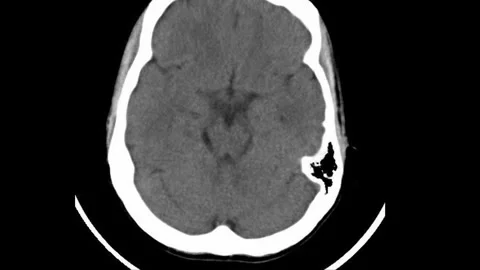 High-resolution MRI scan captures detailed cross-sectional images of the brain Stock Footage 316801296