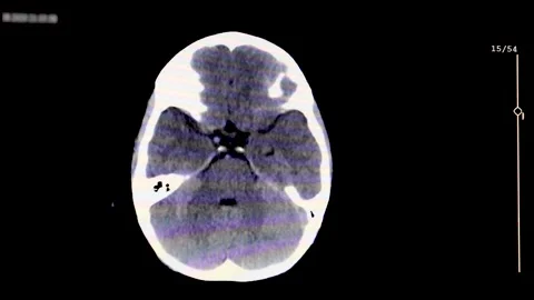 High Resolution Pediatric Brain MRI Scan Showing Normal Skull Anatomy Stock Footage 325390895