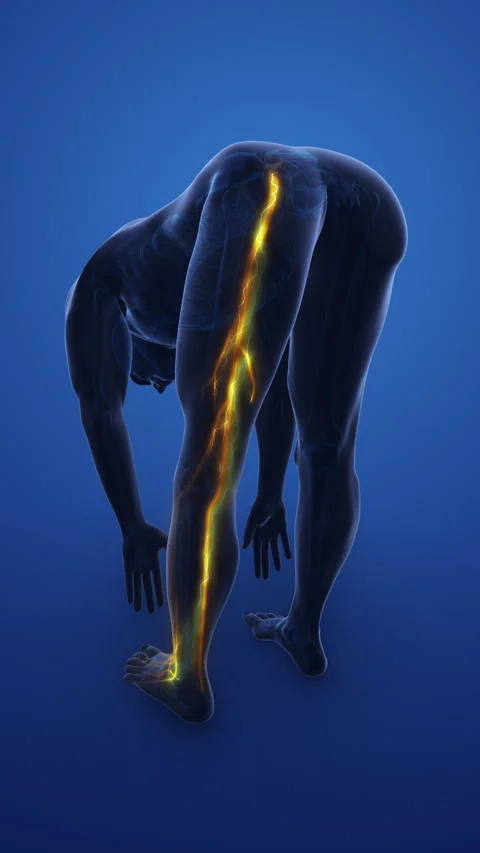Highlighted Sciatica Nerve with Painful Cramps Stock Footage 289609746