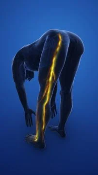 Highlighted Sciatica Nerve with Painful Cramps Illustrazione stock