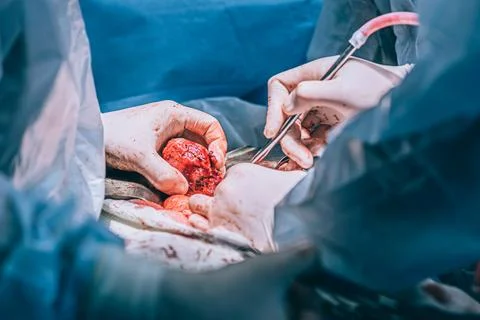 A highly qualified team of surgeons performs a complex operation to remove .. Stock Photos