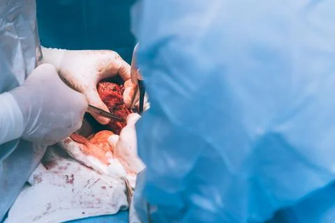 A highly qualified team of surgeons performs a complex operation to remove .. Stock Photos